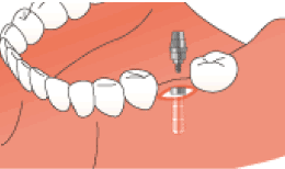 歯肉を開いてアバットメントをフィクスチャーに連結します。