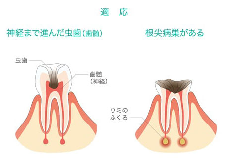 3MIXを適応できる症例は、「神経まで進んんだ虫歯」と「根尖病巣がある場合」です。