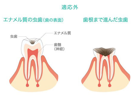 3MIXが適応できない症例は、「エナメル質の虫歯（歯の表面）」と「歯根まで進んだ虫歯」の場合です。