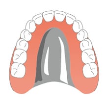 チタン義歯（自費）