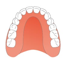 プラスチック義歯（保険）
