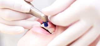 歯のクリーニングで歯垢・歯石・着色を除去している予防歯科の画像