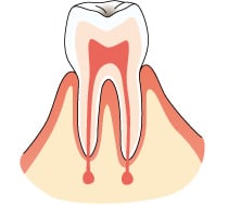 エナメル質の虫歯の画像