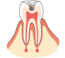 象牙質に達した虫歯の画像