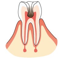 歯髄（歯の神経）に達した虫歯の画像