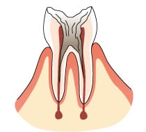 歯冠が崩壊した末期の虫歯の画像