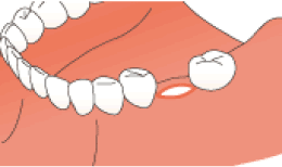 歯のない部位の歯肉を少し切開、骨を露出します
