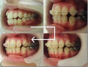 三宮の歯医者のワイヤー矯正の写真