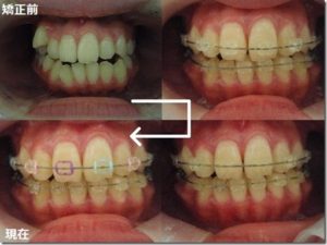 三宮の歯医者の歯の矯正写真