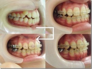 三宮の歯医者の治療経過写真