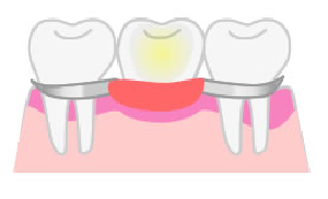 部分入れ歯の画像