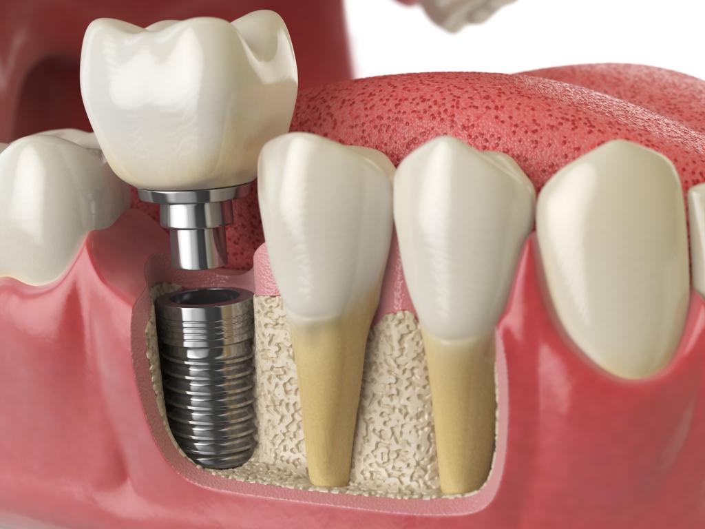 歯科 インプラント トラブル 急増 の 理由